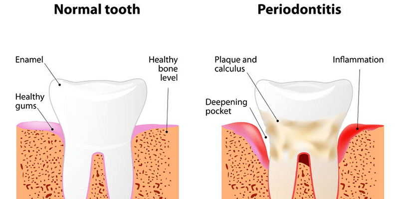 Periodontitis